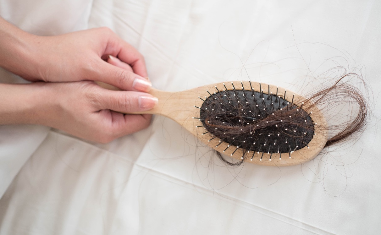 Alopecia Androgenética